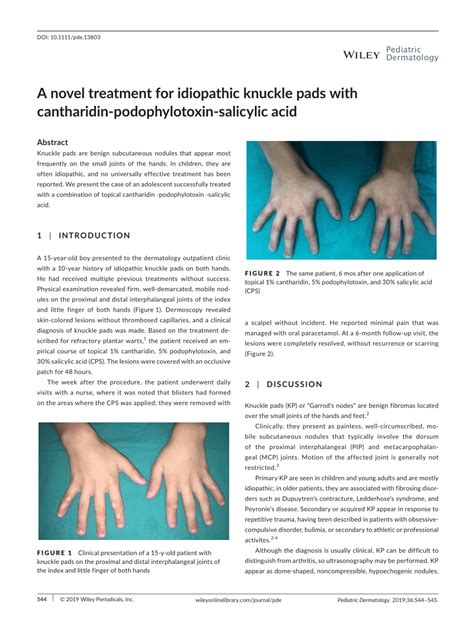 (PDF) A novel treatment for idiopathic knuckle pads with cantharidin ...