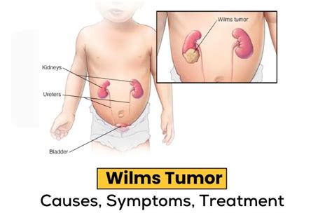 Wilms Tumor: Causes, Symptoms, and Treatment - Dr Apoorva Kulkarni