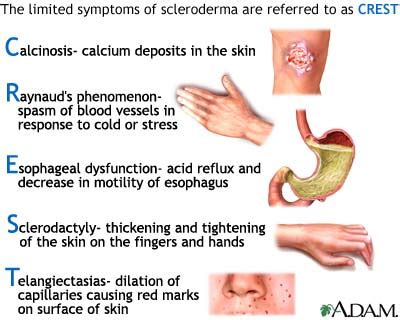 Scleroderma | UF Health, University of Florida Health