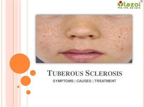 Tuberous Sclerosis : Causes, Symptoms, Diagnosis, Prevention and Trea…
