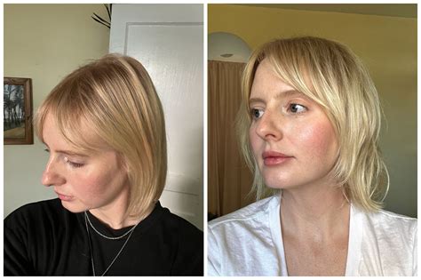 I Got PRP Injections For Hair Loss: See Photos | POPSUGAR Beauty UK