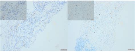 Immunohistochemical CD16 expressions in the first (FB) and second... | Download Scientific Diagram