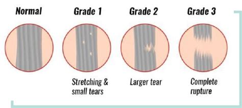 Knee Ligament Injury - AA Active Physio Centre