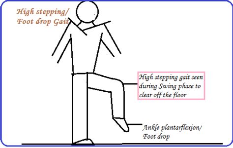 FOOT DROP / HIGH STEPPING GAIT Physiotherapy Mx - PHYSIO STUDY