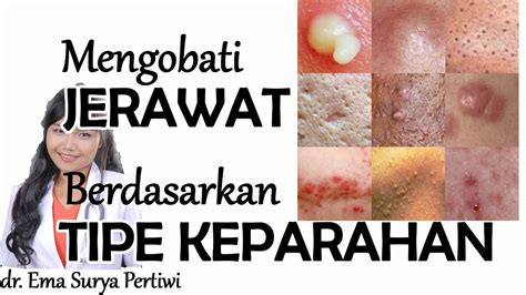 cara merawat wajah: Mengobati JERAWAT PARAH berdasarkan Tipenya