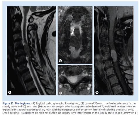 Imaging of spinal cord compression