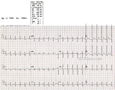 Sinus Tachycardia Rhythm Strip