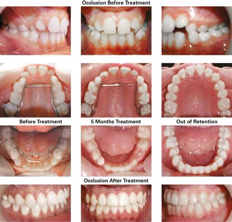 TransForce Palatal Expander - TransForce Orthodontics - Dr William Clark