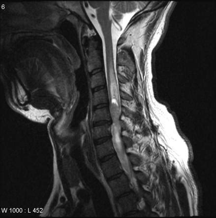 Spinal ependymoma | Radiology Reference Article | Radiopaedia.org