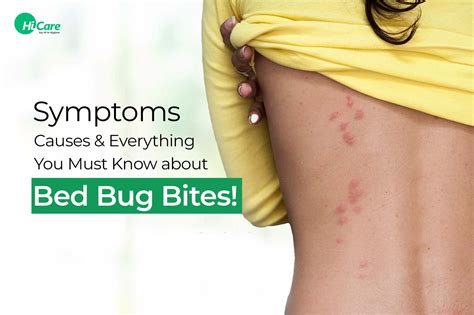 Bed Bugs Bite: Symptoms, Diagnosis and treatment | HiCare