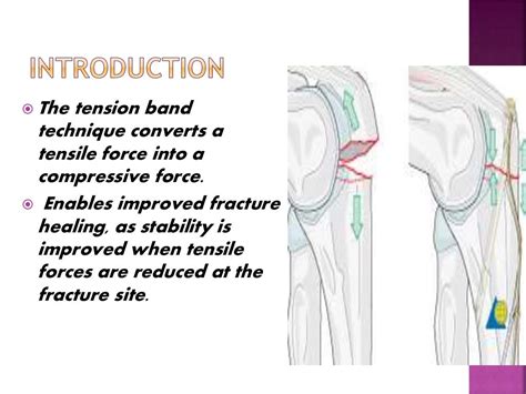 Principle of tension band wiring n its application