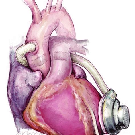 Biventricular assist device (BiVAD) setting. | Download Scientific Diagram