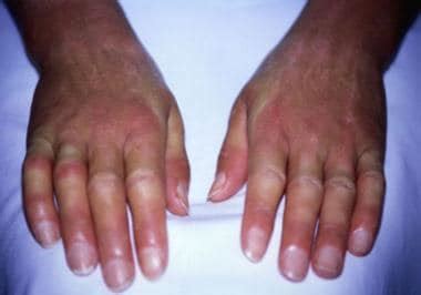 Systemic Sclerosis Clinical Presentation: History, Physical Examination ...