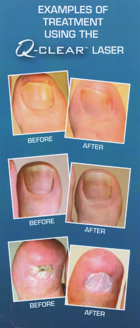 The Latest Thinking on Toenail Fungus | Healthy Running