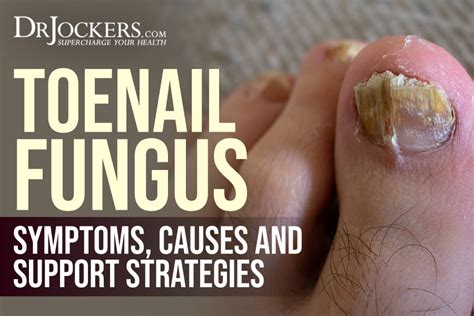 Toenail Fungus: Symptoms, Causes and Support Strategies