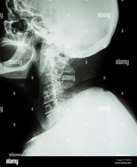 Cervical spondylosis . Film x-ray of cervical spine ( lateral position ) ( side view Stock Photo ...