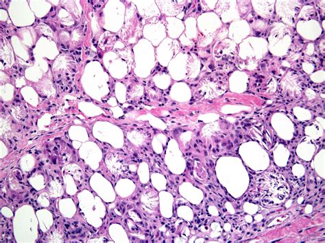 Subcutaneous fat necrosis of the newborn - The Clinical Advisor