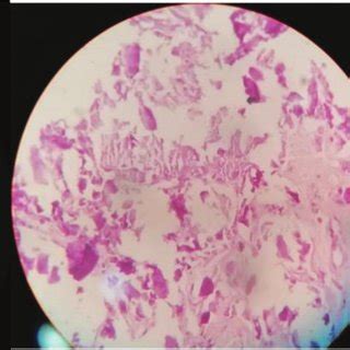 Histopathology specimen of calcified tissue which shows that calcific... | Download Scientific ...