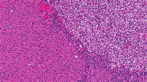 Parathyroid adenoma - MyPathologyReport.ca