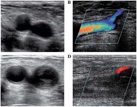 Venous Doppler Ultrasound