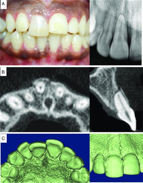 -A, The clinical photograph and radiograph showing a lateral luxation... | Download Scientific ...