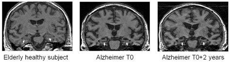 17: Coronal slices of T1 weighted MRI, showing the atrophy of the... | Download Scientific Diagram