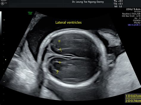 Fetal Hydrocephalus Ultrasound