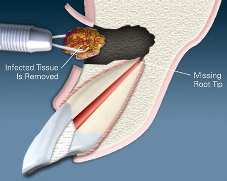 Apicoectomy Greensboro NC, Endodontic Surgery