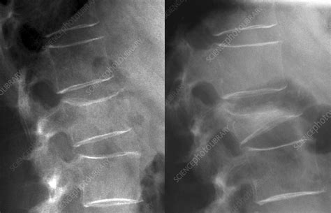 Spine fracture in osteoporosis, X-ray - Stock Image - C013/3034 - Science Photo Library