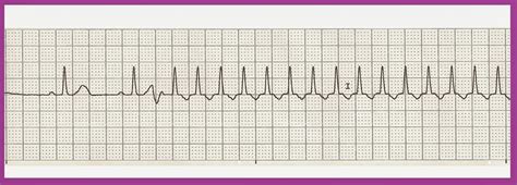 Float Nurse: Practice EKG Rhythm Strips 217