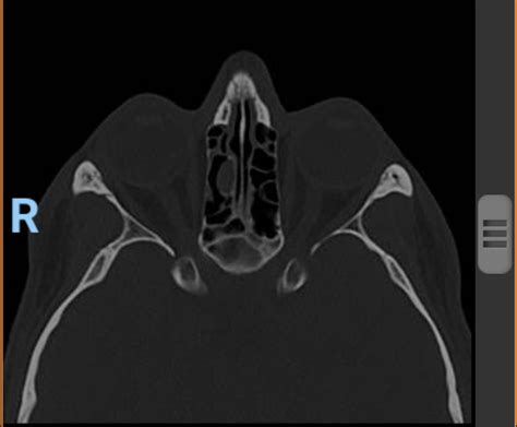 CT Scan. Opacified ethmoid cell. Ignore, inflammation or infection? Virus, bacteria, mold or ...