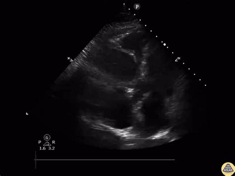 Echocardiography — TPA