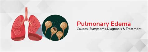 Pulmonary Edema: Causes and Symptoms | BM Birla Hospital Kolkata