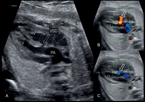 Complete and Congenitally Corrected Transposition of the Great Arteries | Obgyn Key