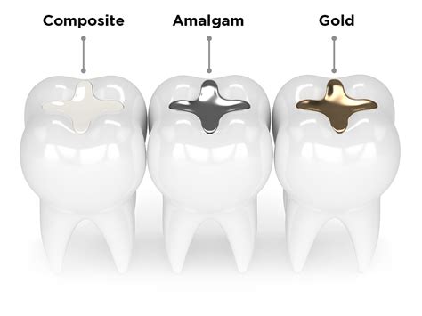 Fillings (Composite Restorations) – Dr. Brant Arnold