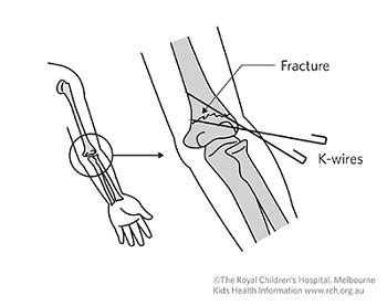 Kids Health Info : Kirschner wires (K-wires)