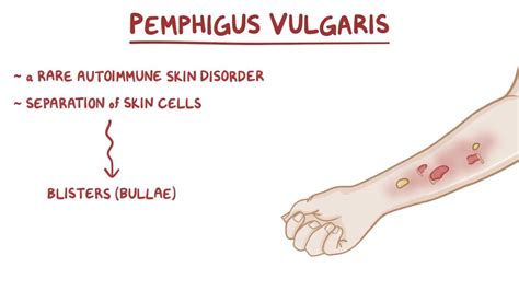 Pemphigus vulgaris: Video, Anatomy & Definition | Osmosis