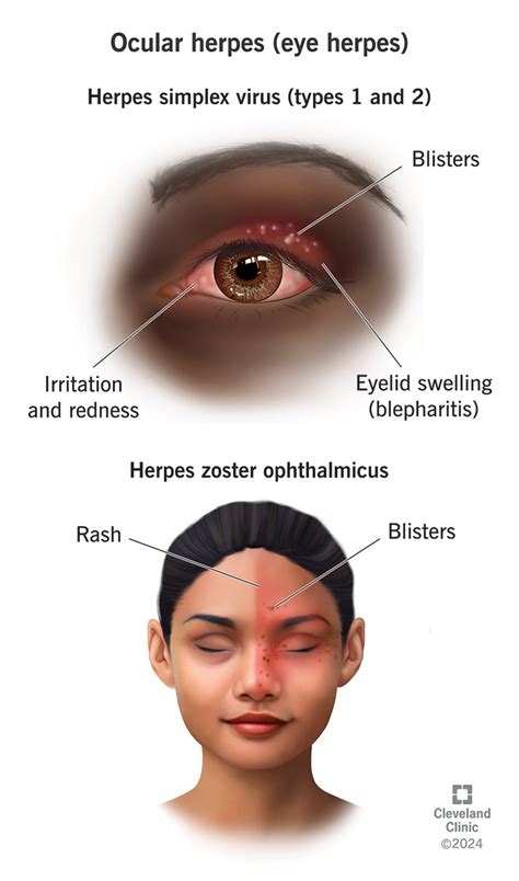 Ocular Herpes (Eye Herpes): Symptoms & Treatment