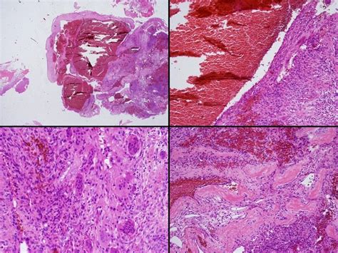 Bone Cyst Histology