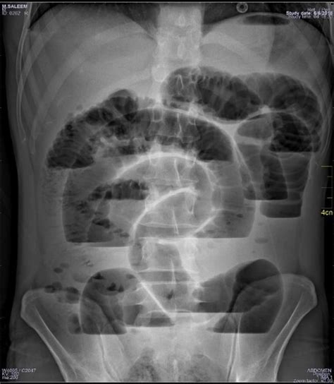 Valvuli conniventis + rigler sign + centrally located dilated bowel loops + multiple air - fluid ...