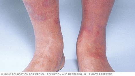 Slide show: Types of dermatitis - Mayo Clinic