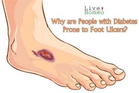 Main Causes of Foot Ulcer - Live Homeo | Live Homeo