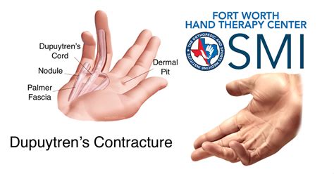 Dupuytren’s Contracture Fort Worth Hand Therapy Center