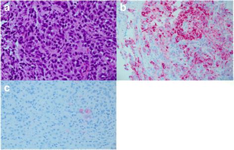 Malignant melanoma visualized by immunohistochemistry. a High-power ...