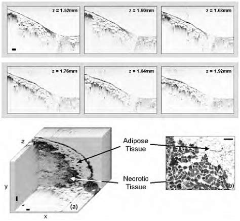 Images of a human lymph node with metastatic and necrotic squamous cell... | Download Scientific ...