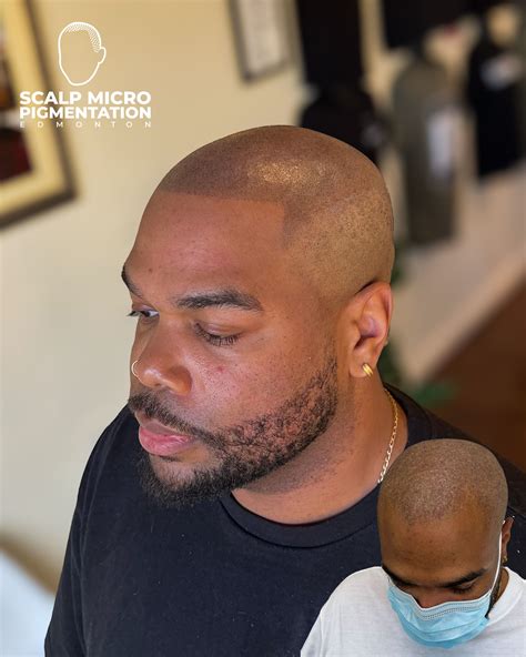 BEFORE & AFTER | Scalp Micropigmentation Edmonton