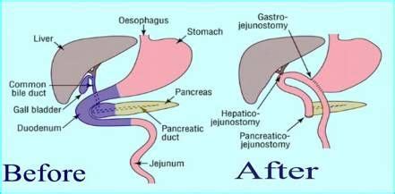 Épinglé par Pam sur Whipple surgery | Étudiantes en école d'infirmière ...