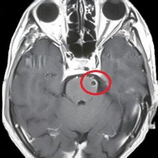 Contrast MRI of Brain showing Ring enhancing T2 hyperintense cystic... | Download Scientific Diagram