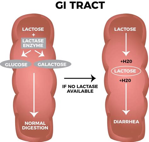 Lactose Intolerance: Symptoms, Causes, and Treatment - Switch4Good