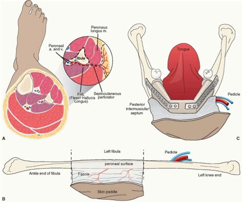 Mandible Reconstruction With Free Fibula Flap | Plastic Surgery Key